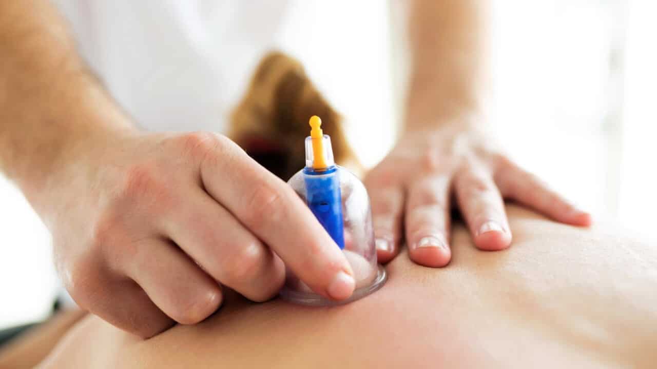 Cupping Therapy Calgary NW Royal Oak